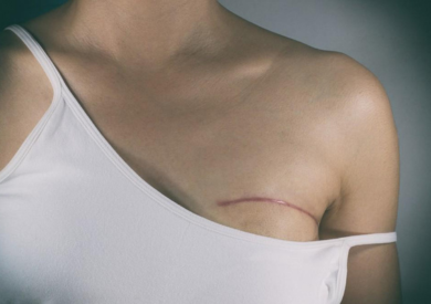 breast surgery